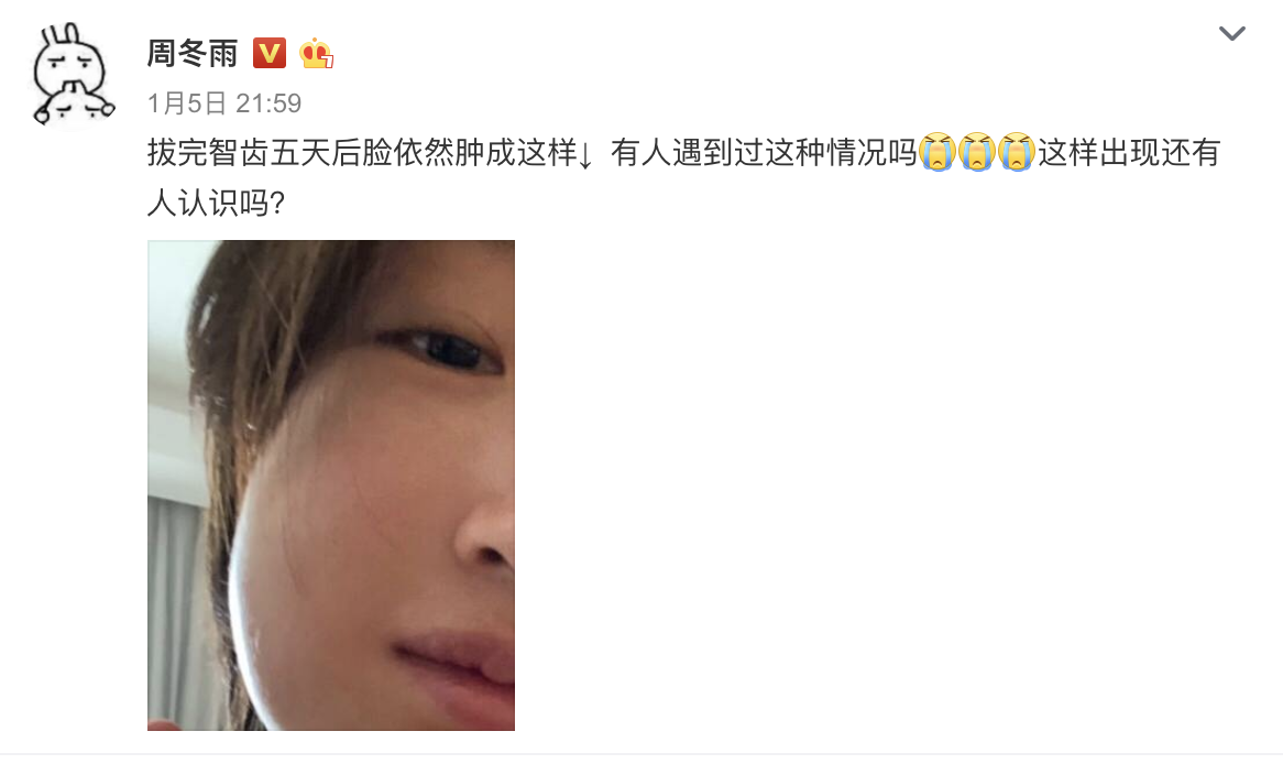 原来,周冬雨不久前拔了智齿,脸肿得非常厉害,她也曾在社交平台上晒照