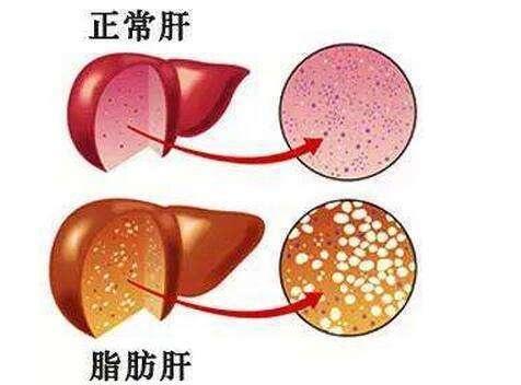 科普｜脂肪肝会引起肝癌，这是真的么？