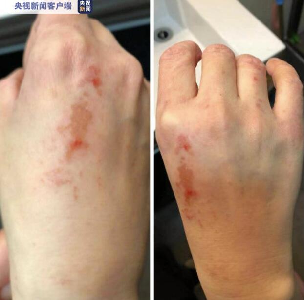 明知自己对防护设备中乳胶手套里面的滑石粉过敏,喻怡冰护士长却毫不