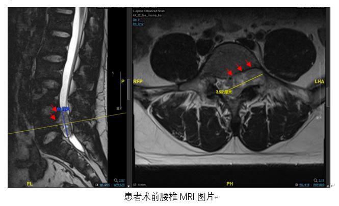 东方网|一个“小手术”摘除了青年男子脊椎管内“大哑铃”状肿瘤