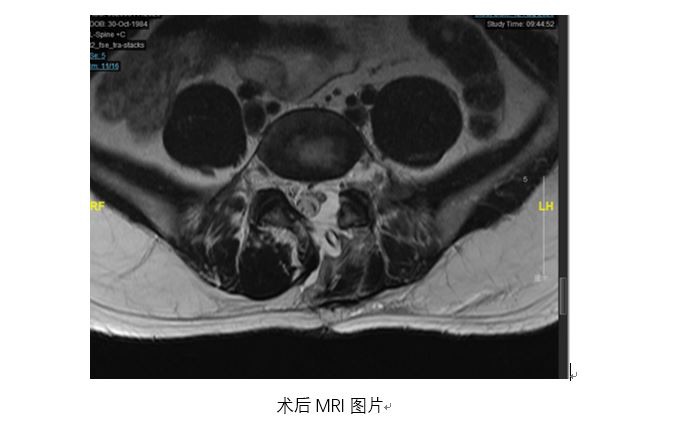 东方网|一个“小手术”摘除了青年男子脊椎管内“大哑铃”状肿瘤