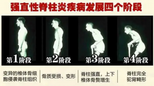 上海松江|方塔中医医院专家教你抬头挺胸向前看