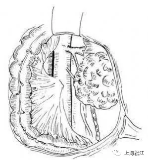 上海松江|全世界公开报道不足百例 子宫肌瘤“爬”进右心房被松江医生成功摘除
