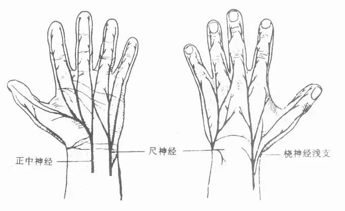 神经卡压性疾病，特征为腕管内正中神经受到压迫，手腕部浅表神经分布。