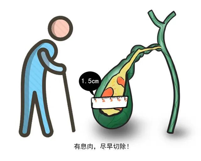 积医科普 | 检发现胆囊息肉怎么办?