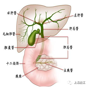 肝外胆管结石是什么,又该如何预防?松江医生来支招