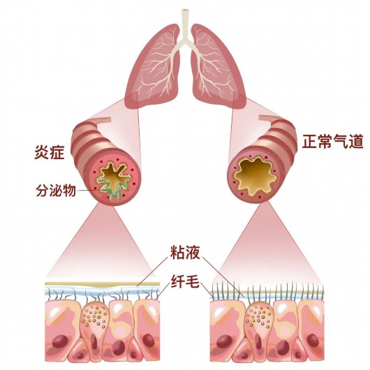 
首都医科大学附属儿童医院黄牛代挂号电话票贩子号贩子网上预约挂号,住院检查加快,肺炎不能掉以轻心，尤其老人和小孩要做好这些事→