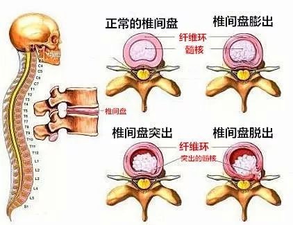 
广州口腔医院黄牛代挂号电话票贩子号贩子网上预约挂号,住院检查加快,科普｜别把腰腿痛当小事！关于腰椎间盘突出症，你关心的问题在这里！