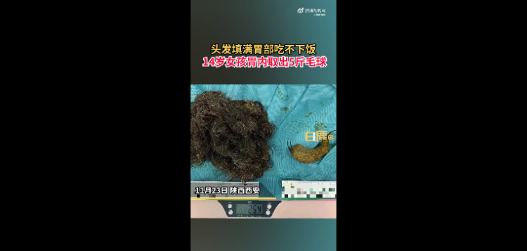 
广州儿童医院黄牛代挂号电话票贩子号贩子网上预约挂号,住院检查加快,女孩胃里取出5斤头发！什么是异食癖？哪些原因会导致这个病？ | 健康你我他