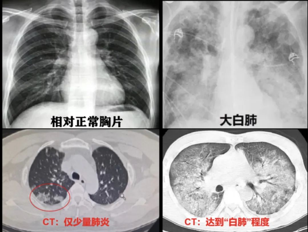 CT影像出现“白色”就是“白肺”？重型肺炎预警信号有哪些？