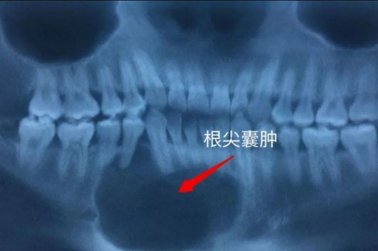 
广州各大医院黄牛代挂号电话票贩子号贩子网上预约挂号,住院检查加快,抽了牙神经牙齿死了吗？丨贤医健康说