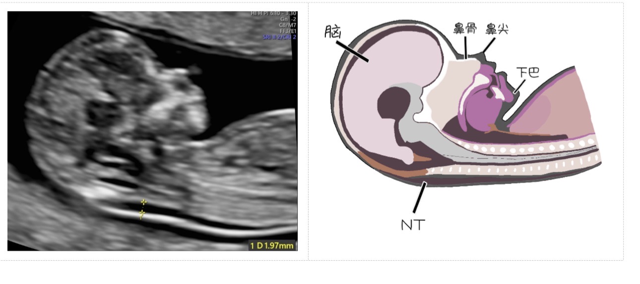 科普｜胎儿NT增厚，是畸形吗？