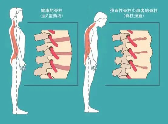 长海医院发现强直性脊柱炎治疗新思路