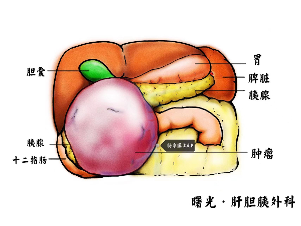 多学科协作"拆弹" 上海专家为年轻姑娘切除15公分胰头部巨大肿瘤