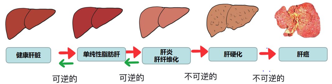 科普｜脂肪肝会引发肝癌，这是真的么？