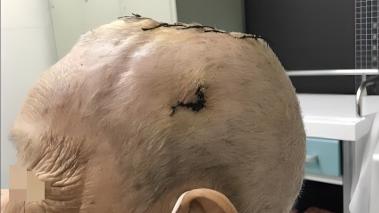 竟是一种罕见的恶性肿瘤