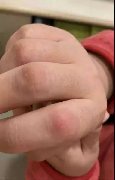 △沈怡敏红肿的指关节